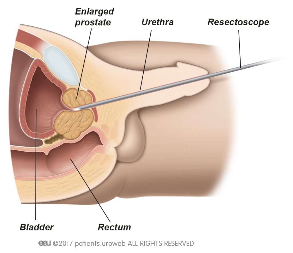 turp prostate surgery