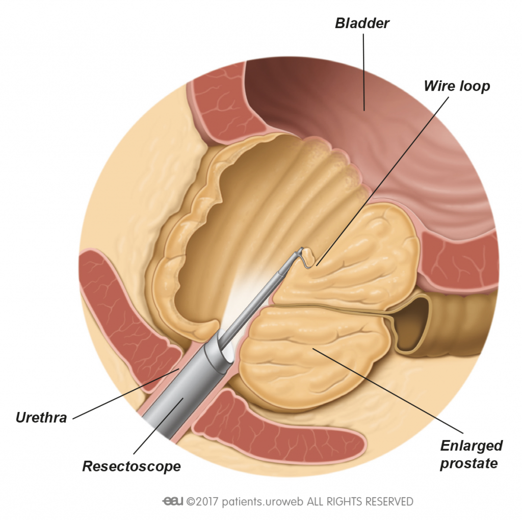 Rezecția transuretrală (TUR) a adenomului de prostată