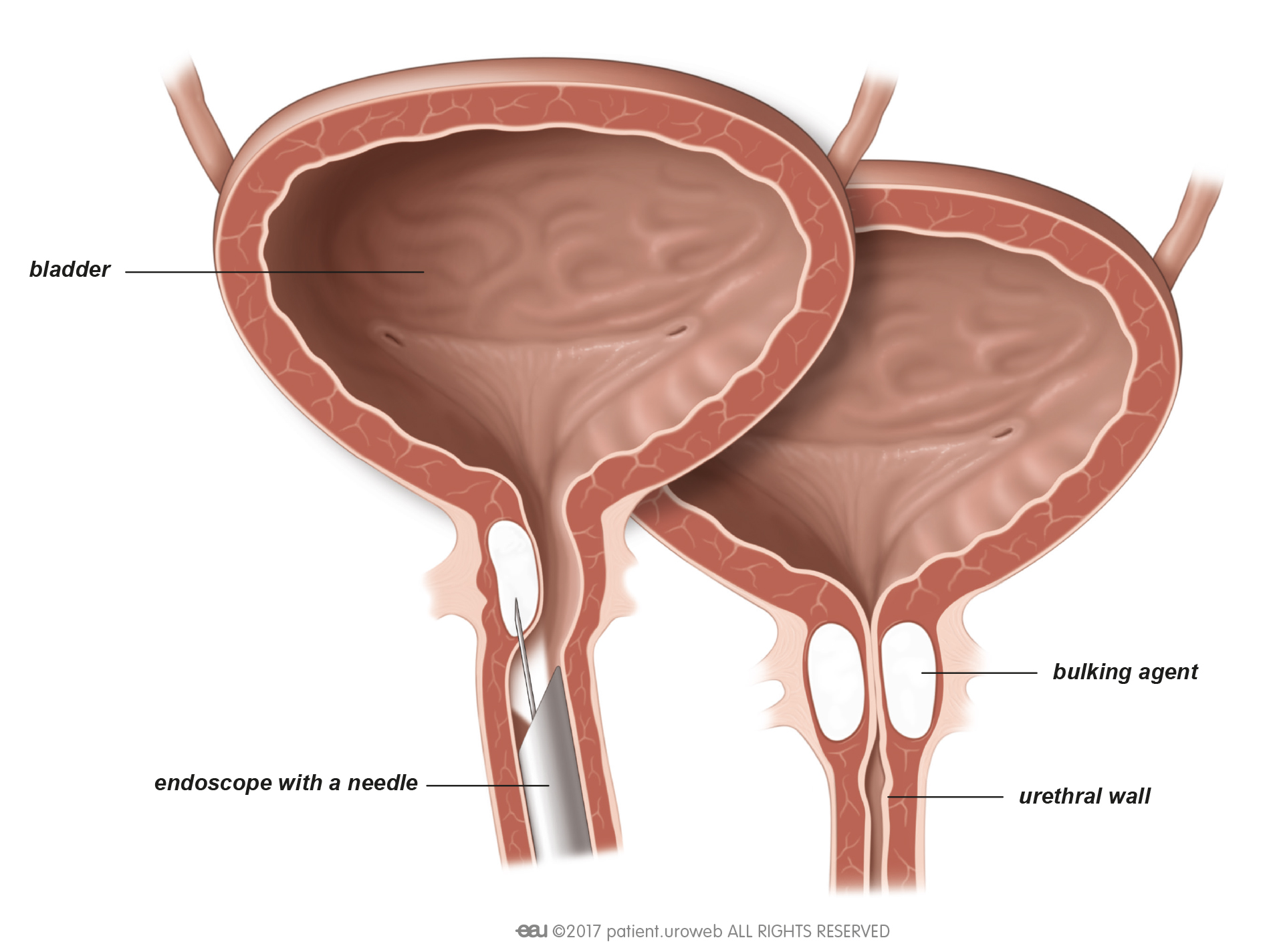 What Is The Best Surgery For Stress Incontinence