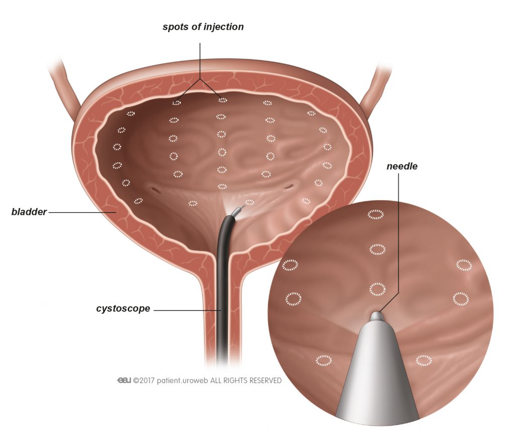 Fig. 1: Botulinum toxin is injected into the bladder wall.