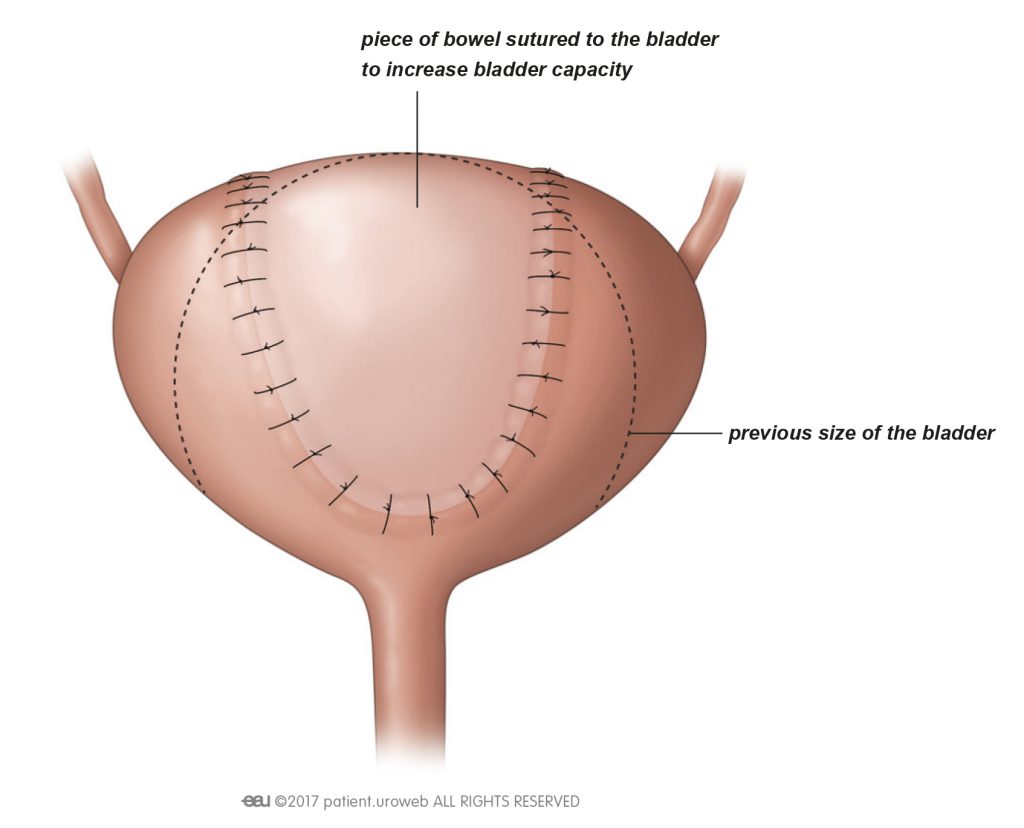 Fig. 1: Bladder surgery to increase the size of the bladder.