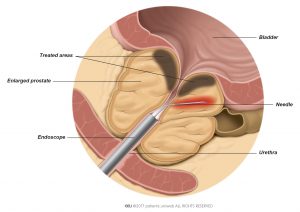 Fig. 1: The needle heats up the prostate tissue with radiofrequency energy.