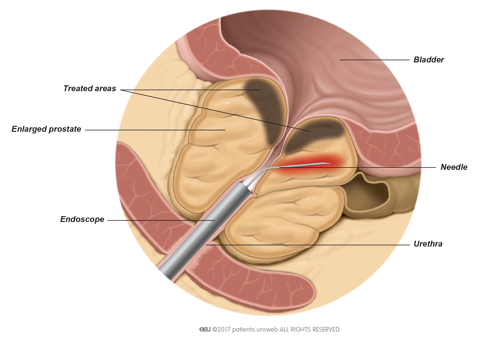 How long is a prostate surgery
