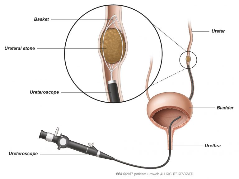 Ureteroscopy With Stone Extraction Cpt Code