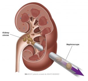 Fig. 1b: Stone fragments are removed in a single procedure with a nephroscope.