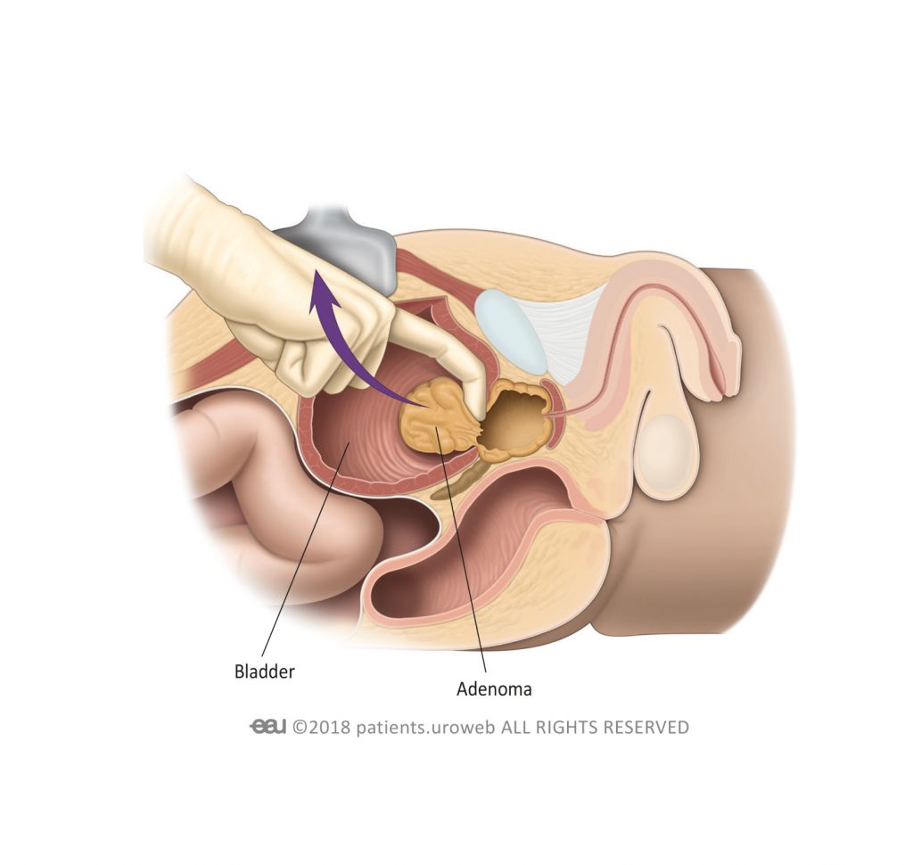 operation adenome prostate