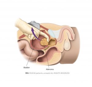 Fig. 1: The surgeon removes the adenoma during open prostatectomy.