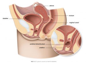 Fig. 6: Bladder and urethra plus diverticulum.