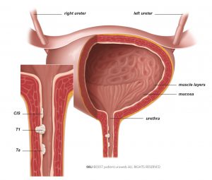 Fig. 7: Localised urethral cancer.