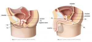 Fig. 8: Advanced urethral cancer.