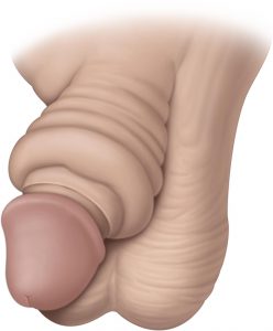 Fig. 4: Paraphimosis