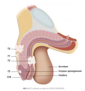 Fig. 2: Penis cancer stages 1-3.