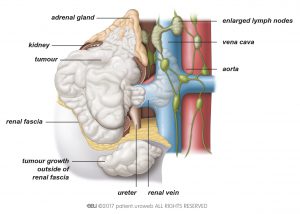 Fig. 5: Stage IV-tumours have spread further outside of the kidney, beyond the renal fascia and into the adrenal gland. Sometimes, one or more lymph nodes are enlarged in this stage.