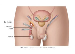 Fig. 5: Orchiectomy - incision in the groin.