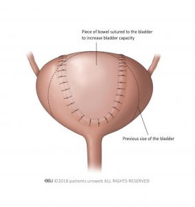 Fig. 3: Bladder surgery to increase the size of the bladder.