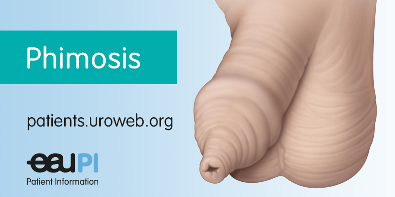Phimosis: how to treat a tight foreskin in adults