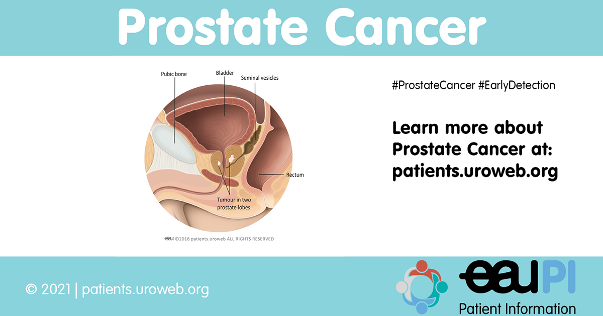 Know Everything About Prostate Cancer Patient Information 3471