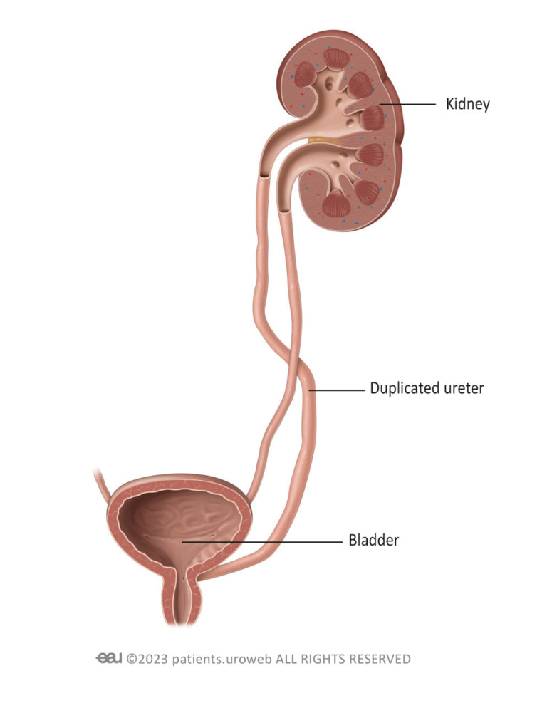 duplex-kidney-ureteral-duplication-patient-information