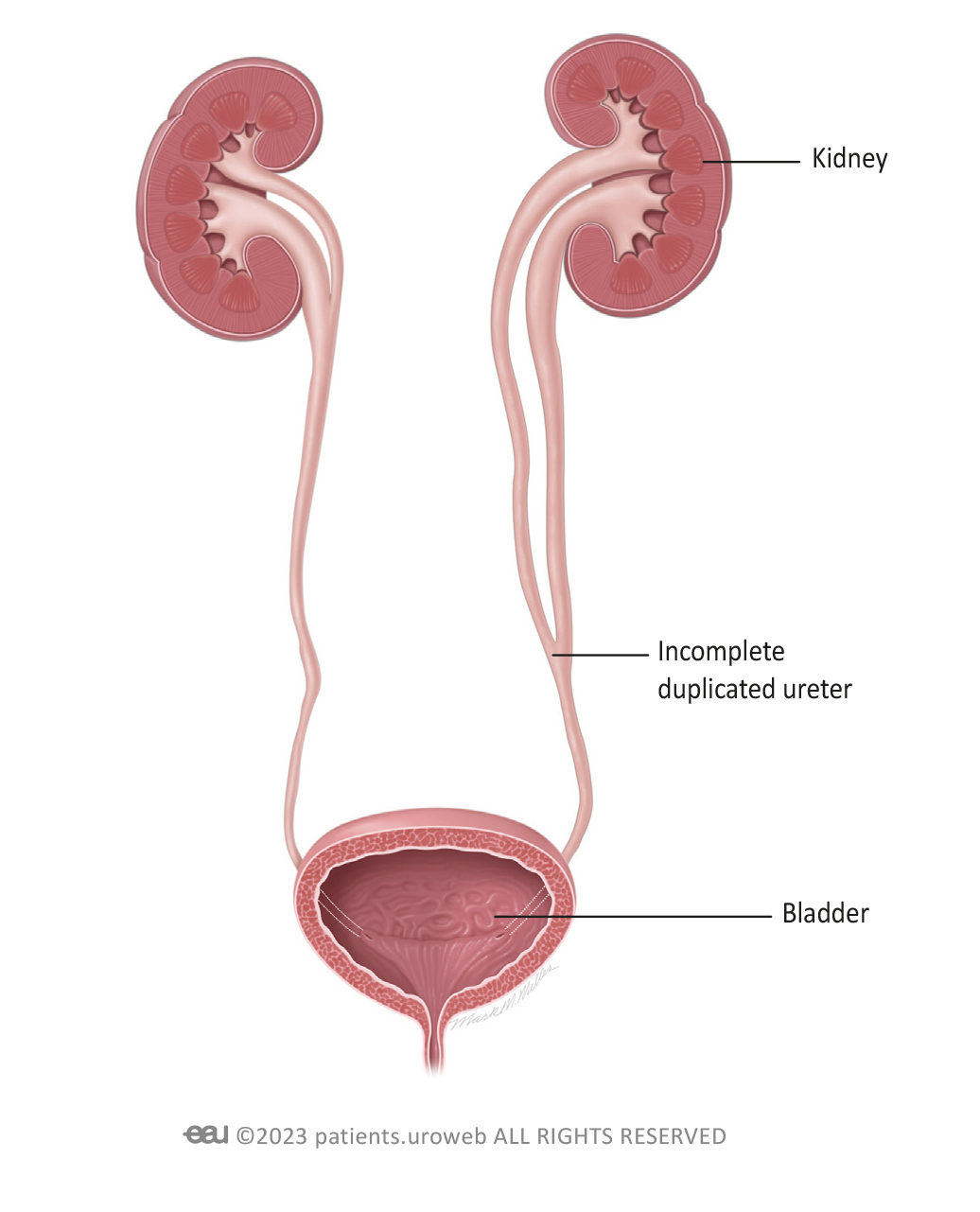 duplex-kidney-ureteral-duplication-patient-information